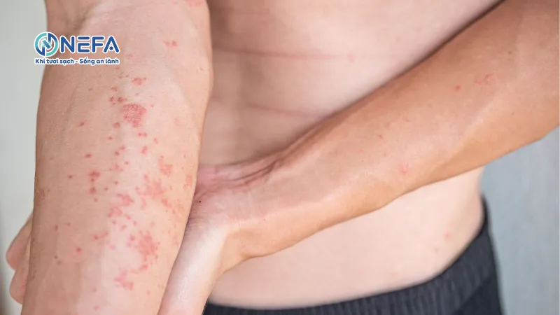 Gây kích ứng cục bộ, làm tổn thương da và niêm mạc