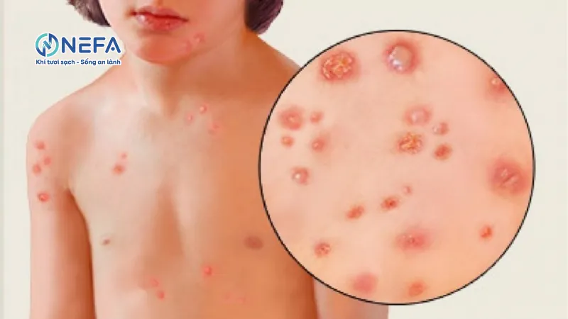 Gây nhiễm khuẩn