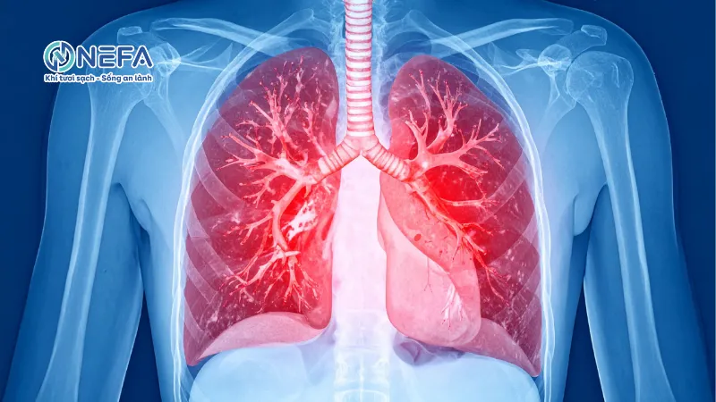 Làm xơ hóa tăng thực gây bệnh phổi mãn tính nặng